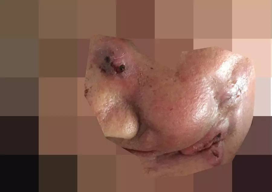 【病例分享】双源癌:面颊部疣状癌 食管鳞癌1例